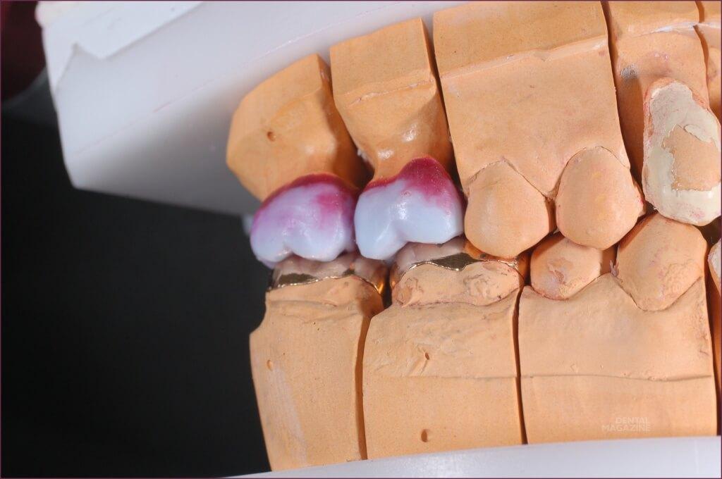 воск в стоматологии
